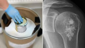 Rusia empieza a emplear un innovador medicamento para el tratamiento de cáncer: ¿cómo es?