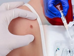 Laboratorios Moderna y Merck logran resultados positivos de una vacuna contra el cáncer de piel